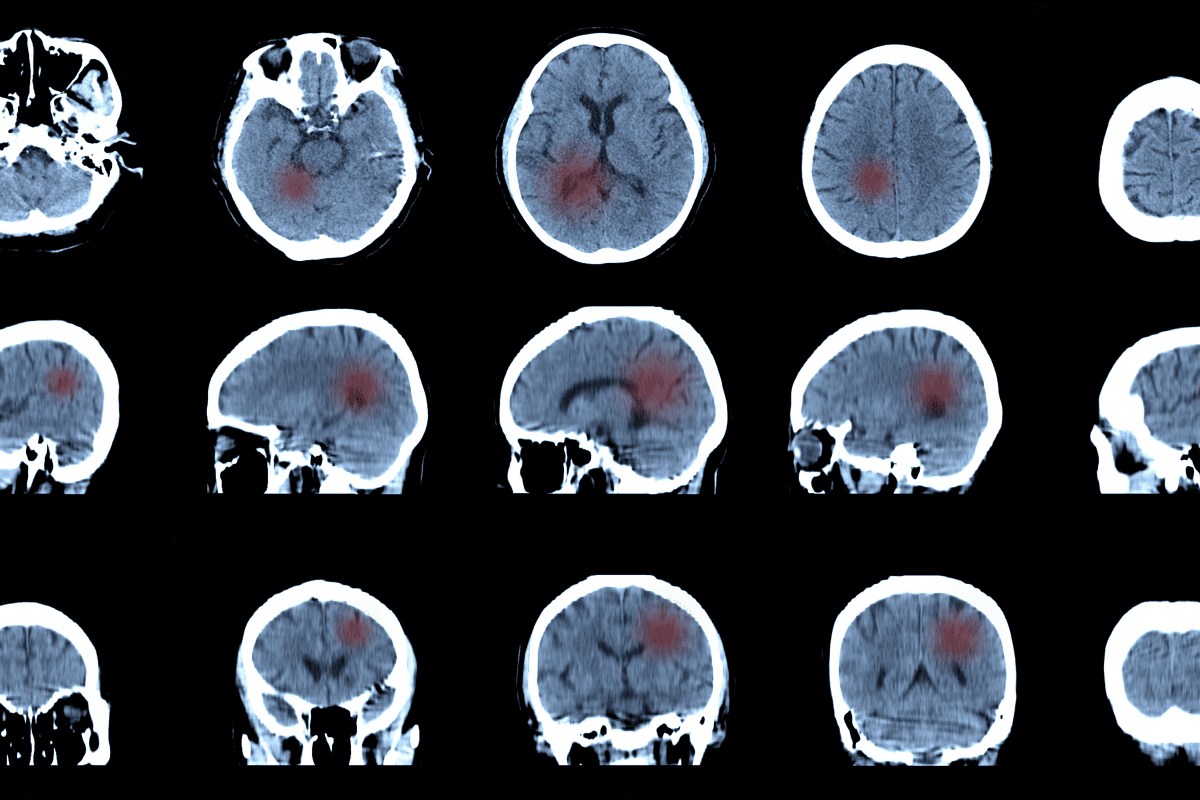 Pediatric Brain Abscess Mystery Cluster in Nevada Worries Investigators