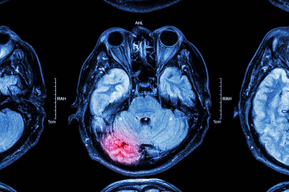 Pharmacologic Management of TBI